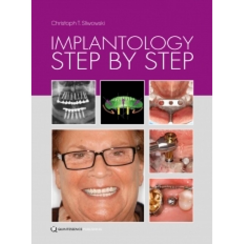 Implantology Step by Step