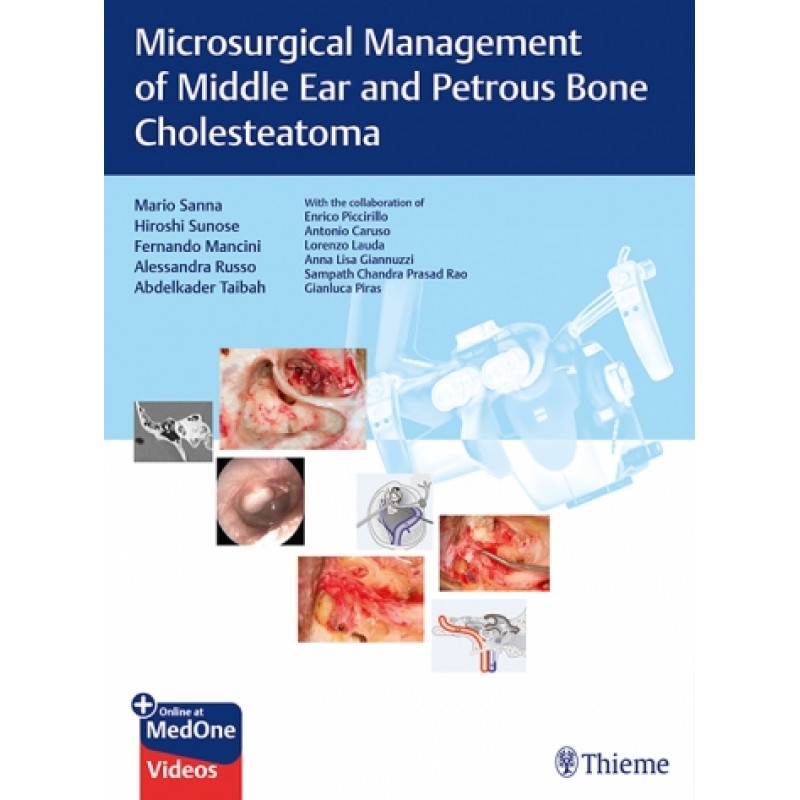 Microsurgical Management of Middle Ear and Petrous Bone Cholesteatoma