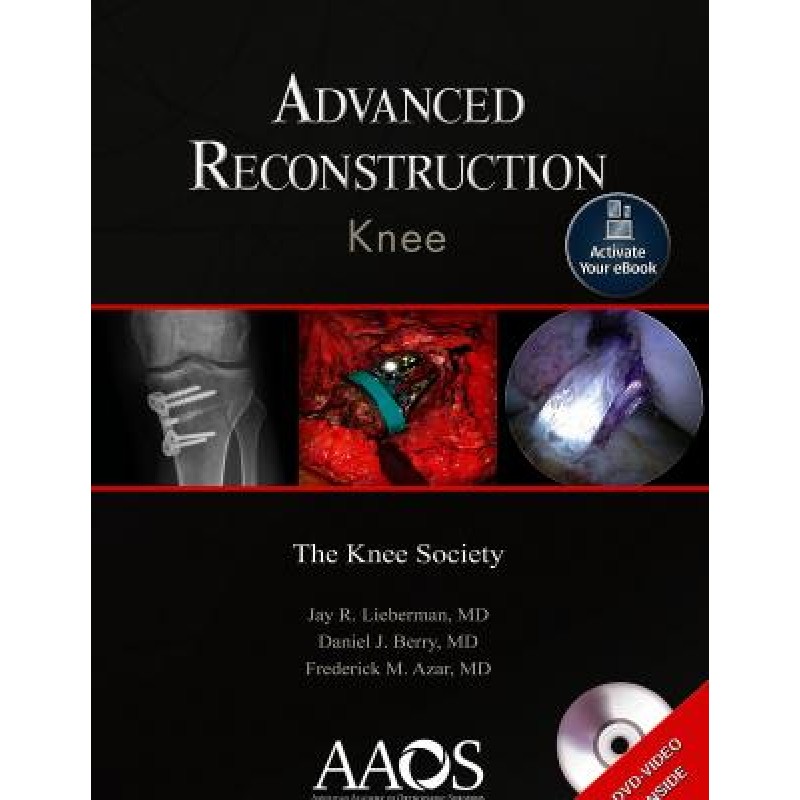 Advanced Reconstruction: Knee