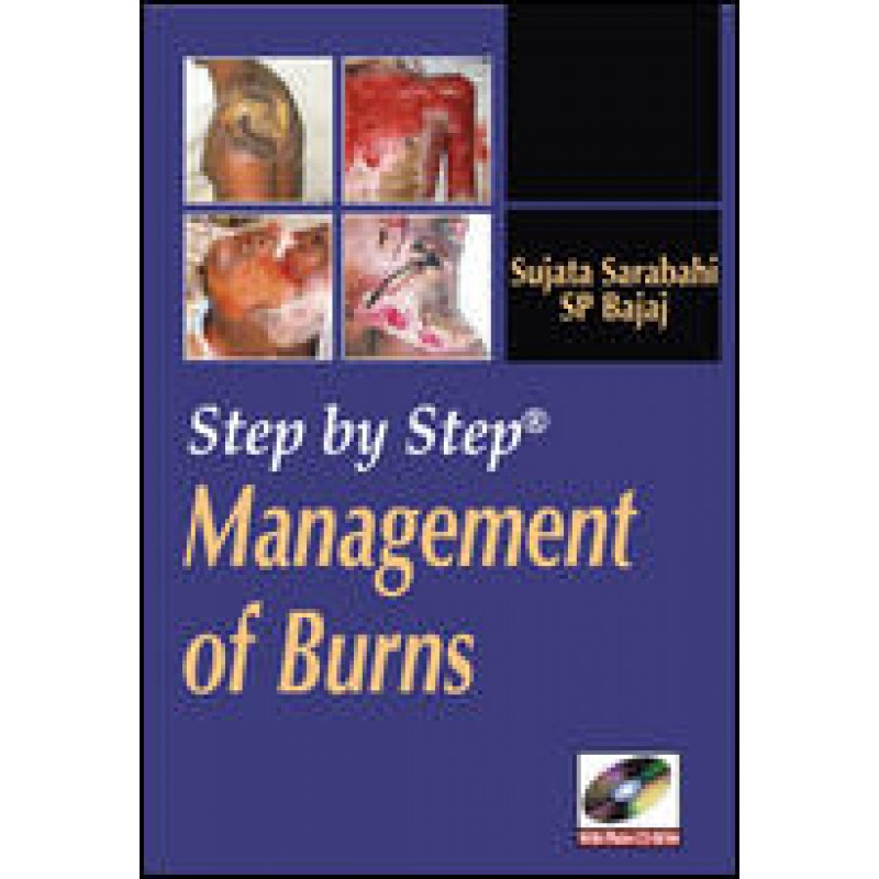 Step by Step Management of Burns