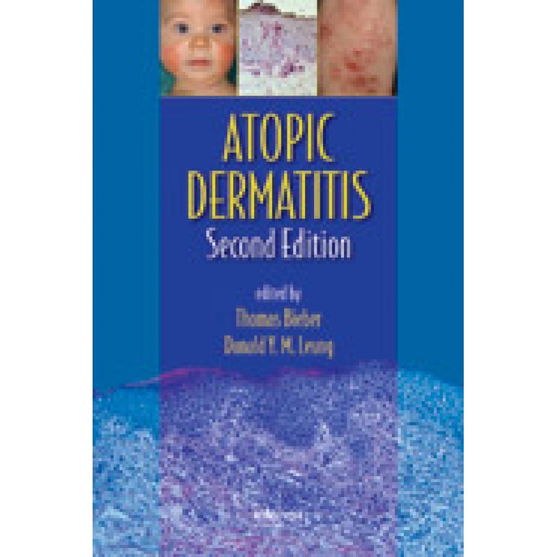 Atopic Dermatitis, Second Edition