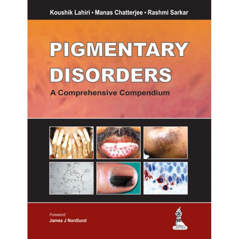 Pigmentary Disorders