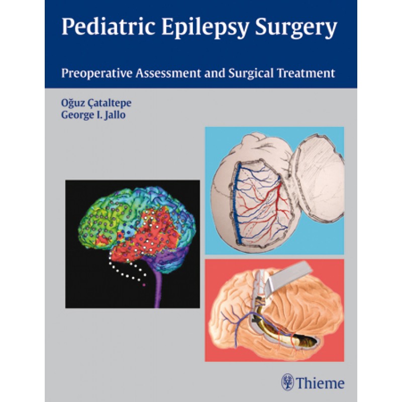 Pediatric Epilepsy Surgery Preoperative Assessment and Surgical Treatment