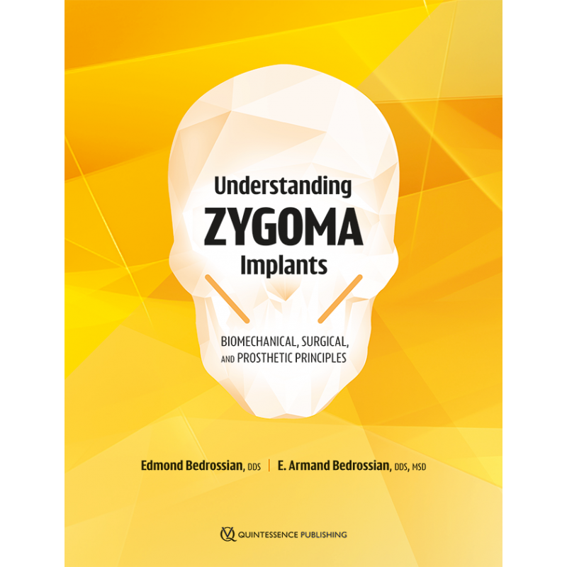 Understanding Zygoma Implants