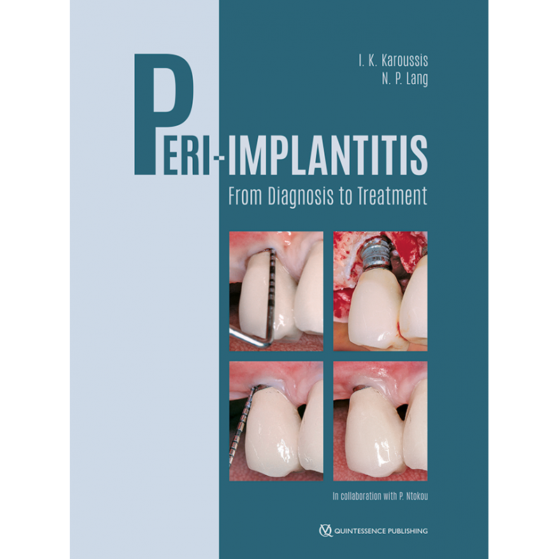 Peri-Implantitis