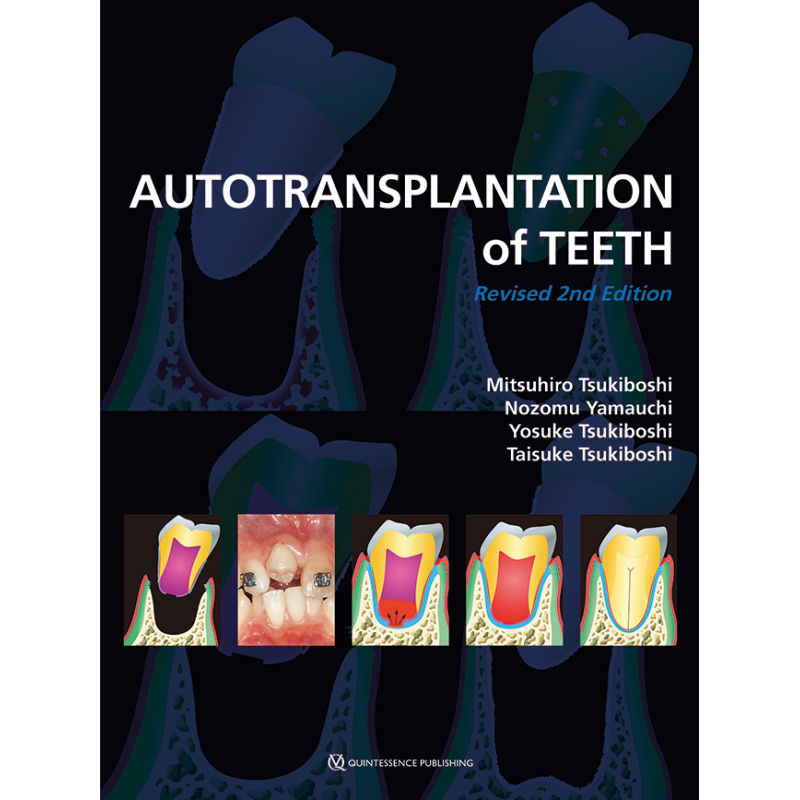 Autotransplantation of Teeth