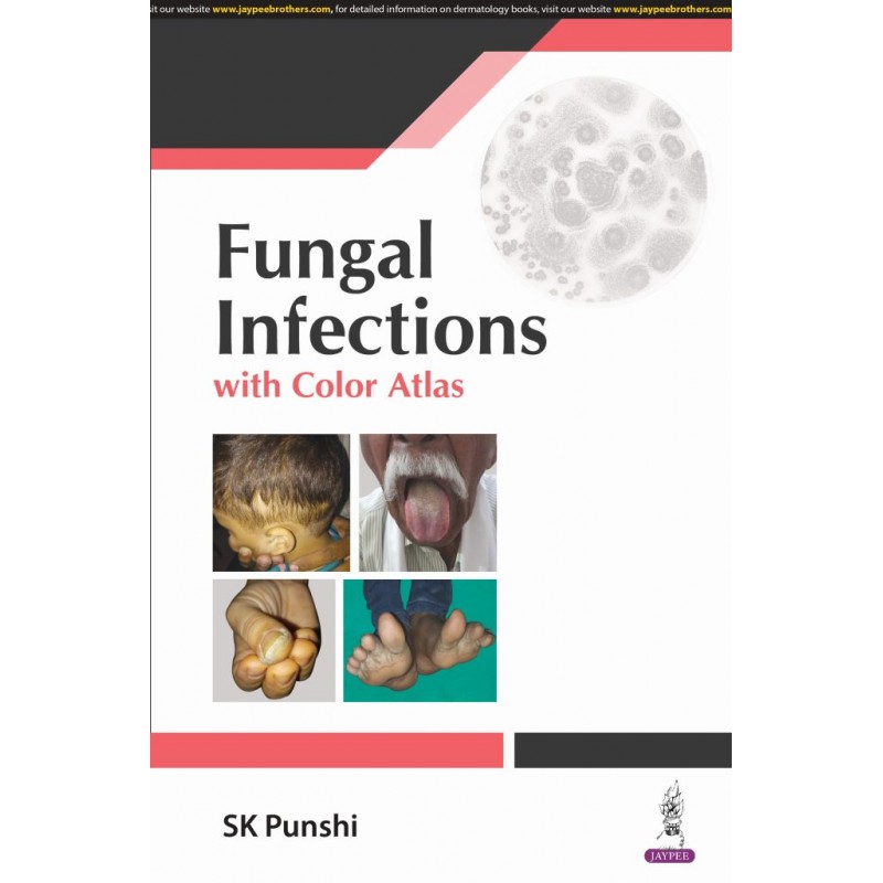  Fungal Infections with Color Atlas