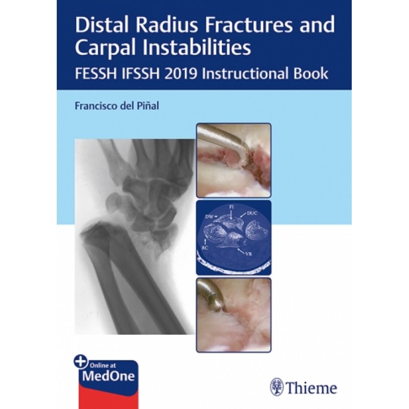 Distal Radius Fractures and Carpal Instabilities