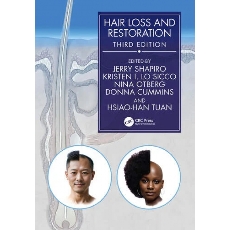 Hair Loss and Restoration - 3rd Edition