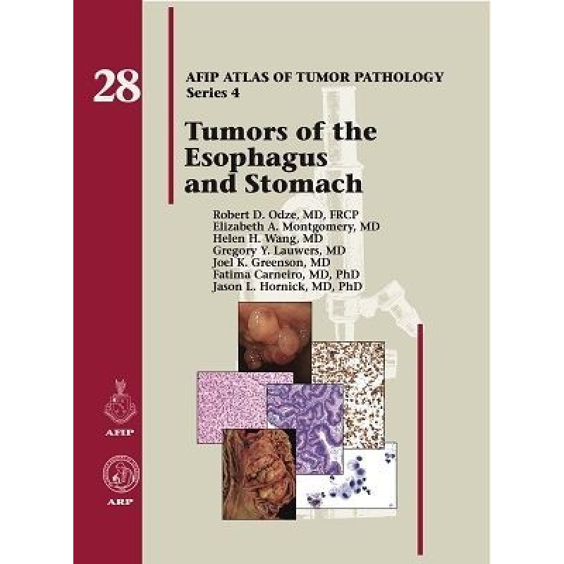 Tumors of the Esophagus and Stomach